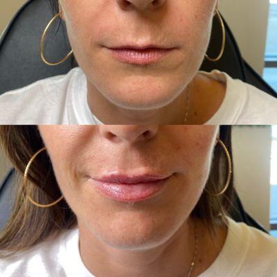 Fillers can look natural  #naturallips #lipfiller #smalllips #chicagolips #chicagolipfiller #mountprospect #medspanearme #medspa