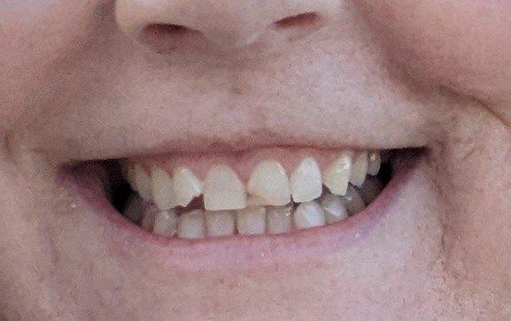 This is what my teeth looked like a few days before the bonding fell out. A bit discolored, but overall fine.