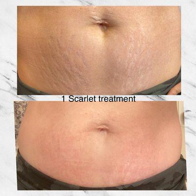 One week after a Scarlet SFR Microneedling treatment for Stretchmarks