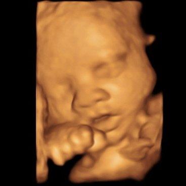 3D Ultrasound from BB Precious