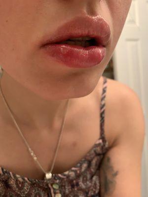 Busted and infected lip