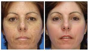 IPL Photofacial targets pigment issues, such as brown spots, sun damage, red spots, Rosacea and more 
 http://www.medrevive.com/index.php