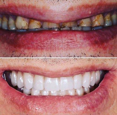 Damaged teeth due to sever grinding and soda, all restored with Cosmetic Crowns.