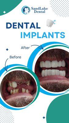 Before and After Dental Implants