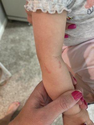 Unreported bite marks On a 10 month old.