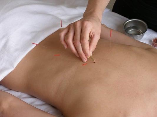 Applying okyu-moxa to acupuncture point at Gotham Wellness Acupuncture Soho. Cosmetic Facial Acupuncture.