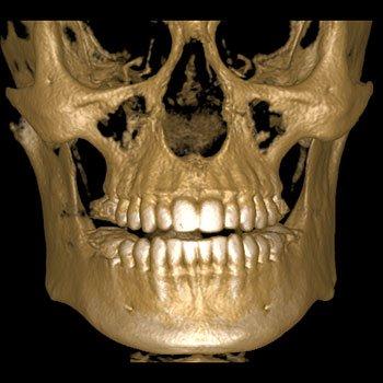 Our office utilizes technology to produce three dimensional (3-D) images of your teeth, soft tissues, and bone in one scan.