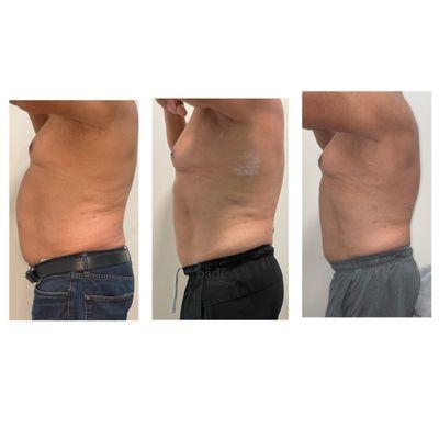 Inch Loss Infrared Detox Wrap. These results are after 2 sessions!