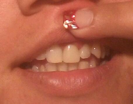 My new and replaced tooth, in 12 hours after my freak accident Saturday night at the concert. =D  THANK YOU GUYS!!!