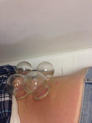 Cupping