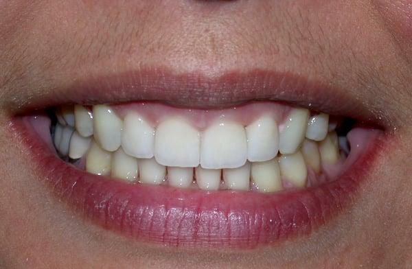 After Veneers