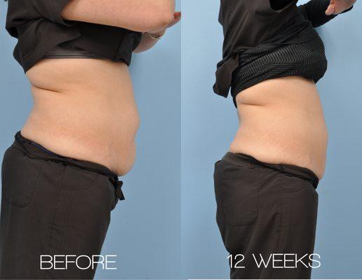 Non-surgical fat reduction