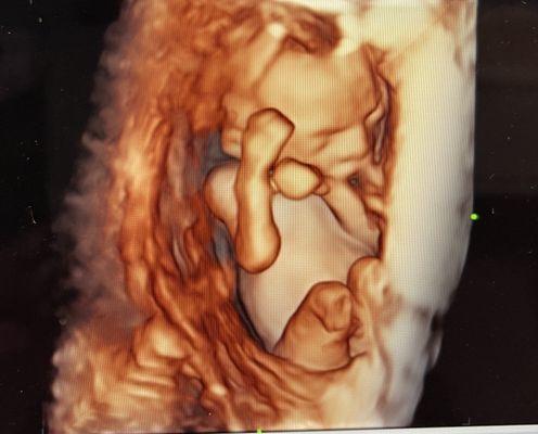 Baby cuddled up in the uterus :) 3D ultrasound