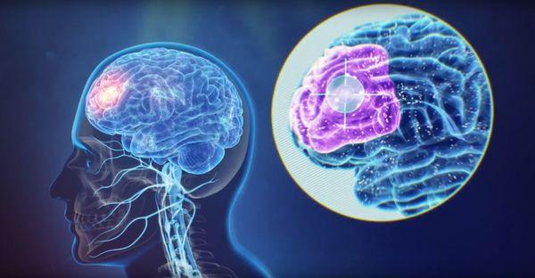 Dorsolateral prefrontal cortex (DLPFC): The brain region responsible for mood which TMS targets.