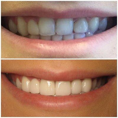 Cosmetic Veneers.