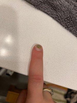 Fungus under nail