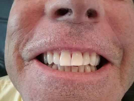 After treatment of DaVinci Teeth Whitening