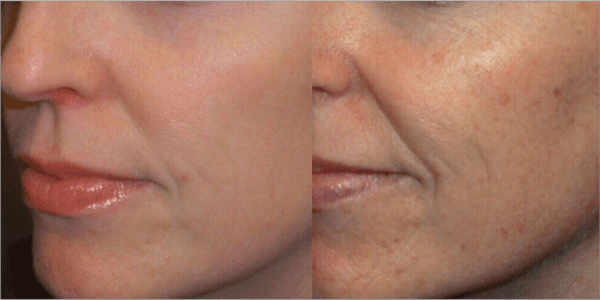 TriBella results