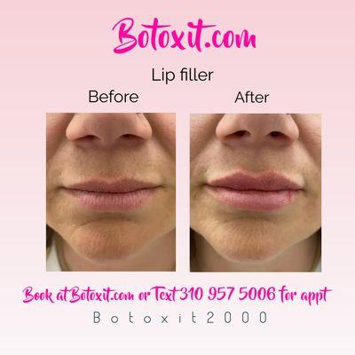 Lip filler