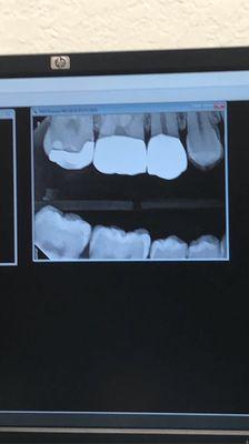 This is a photo of the teeth they worked on. Pay extra close attention to the last tooth.