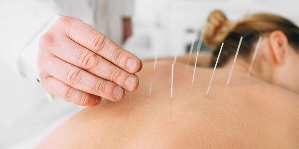 Have you heard of Dry needling and the amazing results patients are getting with their pain? Call 727-384-4600 more information