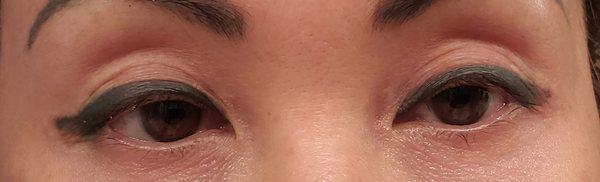 My perfect eyelids 1 month before surgery with Dr. Cohen.