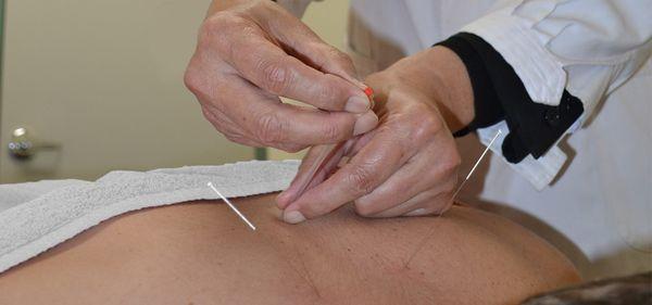 TCM Acupuncture Treatment