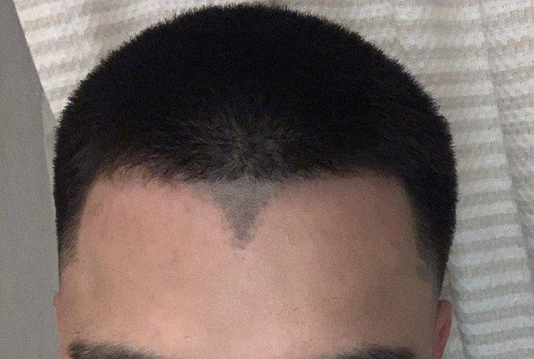 The work speaks for itself. I came in for a widows peak removal & this is the result after the first treatment.