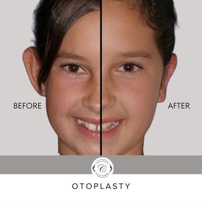 Otoplasty (Ear Pinning Surgery) Can be performed on children as young as 5 years old.