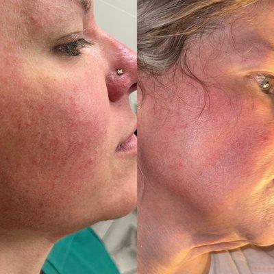 Laser Facial and vein removal