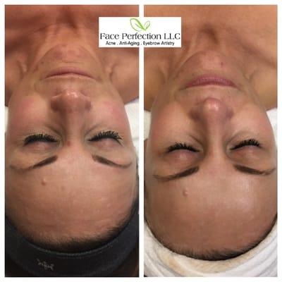 Micro Needling & Home Care, after 1 treatment