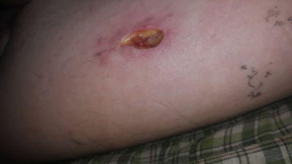 This is the results of this doctors stitching job.  I am filing a complaint with the state medical board.