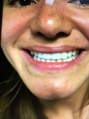 DMV Teeth Whitening.            40 minutes session