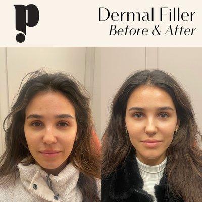 Dermal Filler by Felisha J.