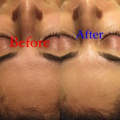 Client's concern was rough, dull, dry, dehydrated skin. Immediately after the facial, skin is radiant, hydrated and smooth.