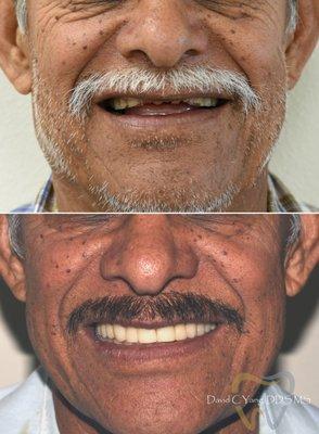 Crown smile rehabilitation - looking 10 years younger!