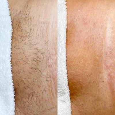 Before and After Brazilian Sugaring Treatment *no skin damage or burns*