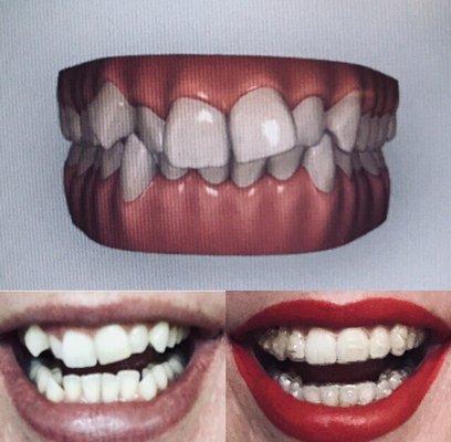 Invisalign treatment after 5 1/2 months