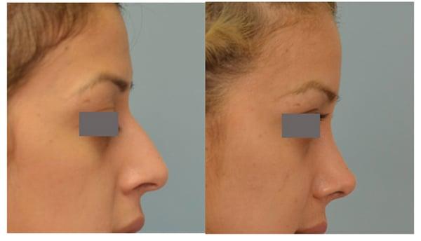 Closed rhinoplasty by Dr. Grigoryants