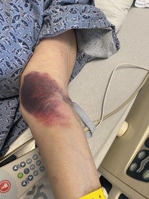 Not a good IV placement... I asked to have it moved when I saw the bruise... sad it had to be noticed by me after a while.