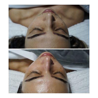 Before and after dermaplane facial