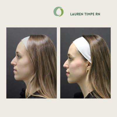 Before + after cheek, chin and lip filler by Nurse Lauren Timpe