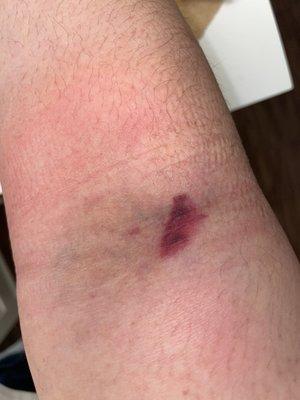 Hematoma