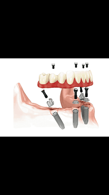 Dental Implants