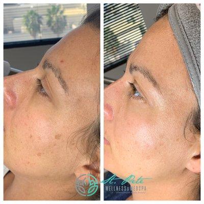 IPL TREATMENT- before and after 1 treatment