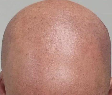 Micro scalp pigmentation before photo.