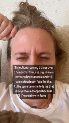 Bad Botox by nurse Gigi