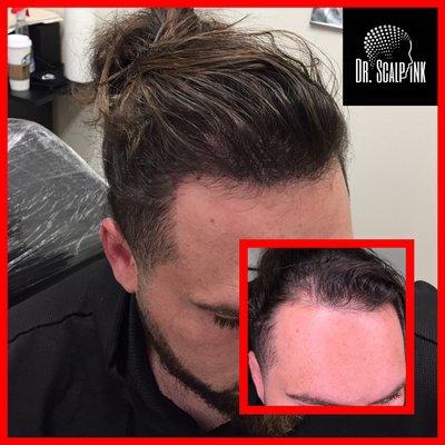 Density added to thinning hair using scalp micro pigmentation