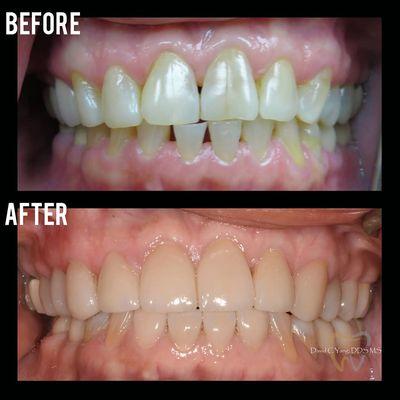 Cosmetic Veneers