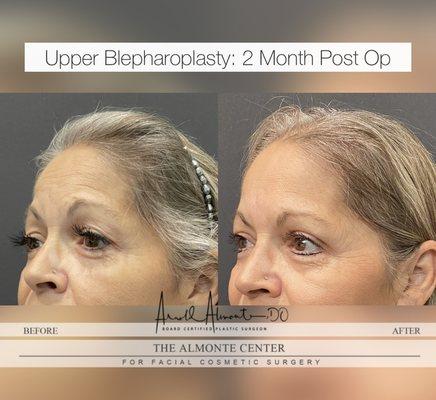 Before & After: Upper Blepharoplasty